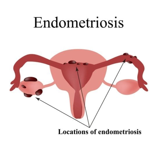 Endometriosis Qué Es Síntomas Y Tratamientos Dra Marta Sánchez Dehesa 3516