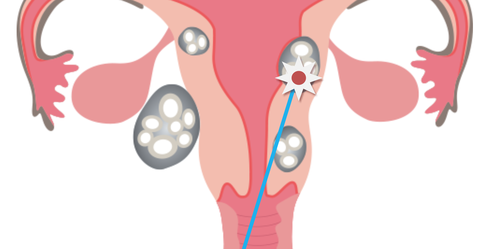 radiofrecuencia_miomas_uterinos
